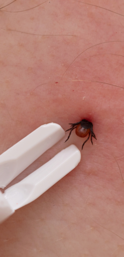 Ziekte van Lyme - Teekverwijdering (lang)